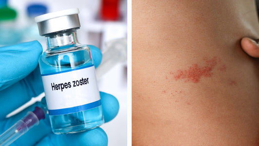 Vacunación contra Herpes Zoster