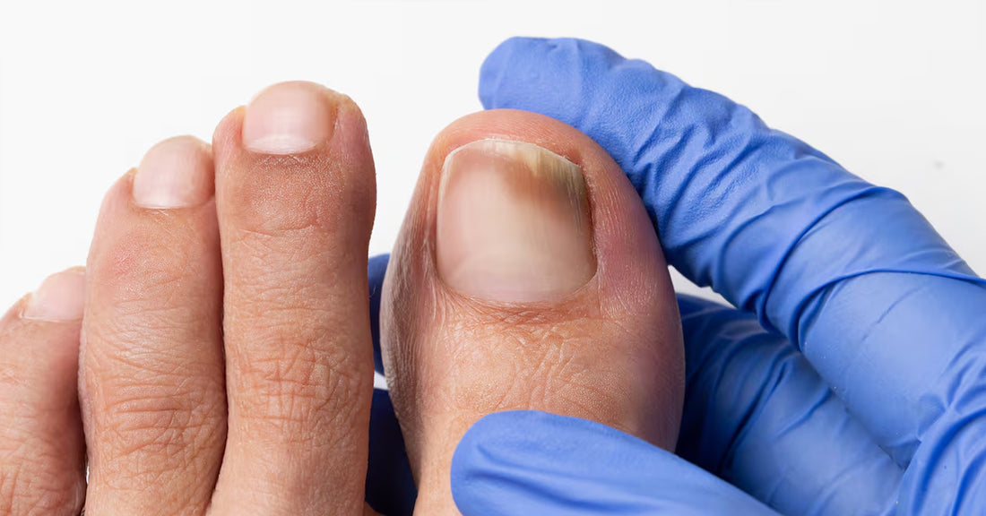 Problemas Comunes en las Uñas de los Pies: Guía Completa de Prevención y Tratamiento